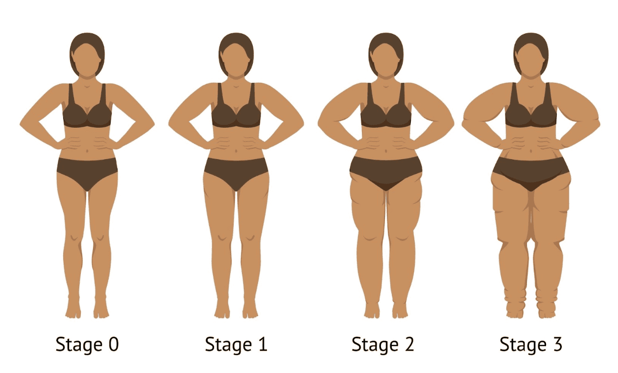 How to Help Lipedema and Lymphedema - Part 2